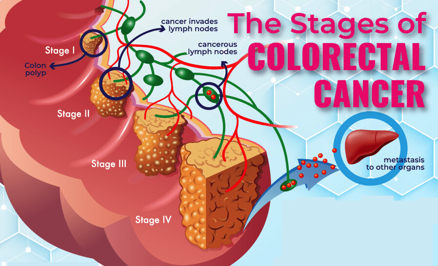 stages of colon polyps