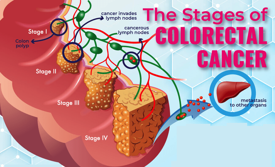 colorectal cancer colon dr astha bhatt