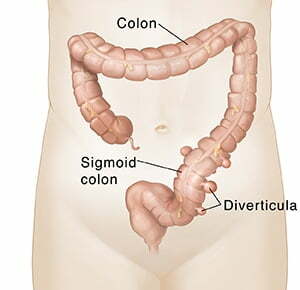diagnose Colon Diverticulitisr disease, Colorectal Surgeon