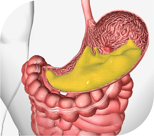 colon diverticulitis fort lauderdale treatment
