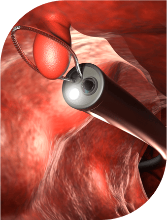 Colonoscopy a screening colonoscopies procedure in Fort Lauderdale, FL, Pompano Beach, FL, Deerfield Beach, FL, Wilton Manor, FL, Oakland Park, FL, Davie, FL, Plantation, FL, Coral Springs, FL, Margate, FL, Coconut Creek, FL and surrounding area of Broward County, Florida