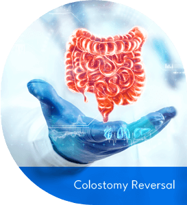 Colostomy Reversal Surgery Fort Lauderdale, FL, Pompano Beach, FL, Deerfield Beach, FL, Wilton Manor, FL, Oakland Park, FL, Davie, FL, Plantation, FL, Coral Springs, FL, Margate, FL, Coconut Creek, FL and surrounding area of Broward County, Florida