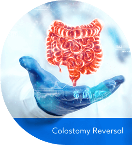 Colostomy Reversal
