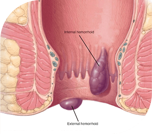 painless hemorrhoids treatment fort lauderdale pompano beach