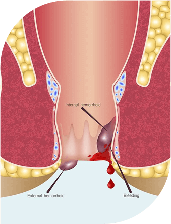 Best Hemorrhoids treatment fort lauderdale
