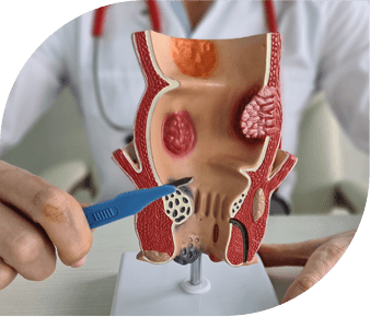 Hemorrhoids surgeon fort lauderdale