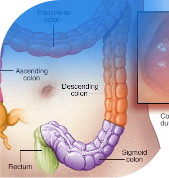colorectal cancer broward county