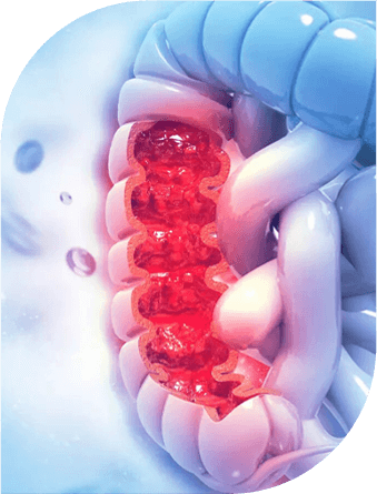 colon cancer broward county