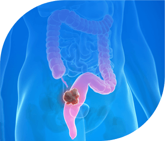 colon cancer rectum cancer expert treatment