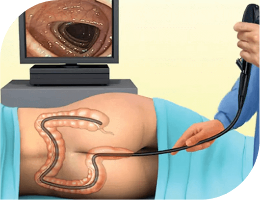 prevention of colorectal cancer colonoscopy