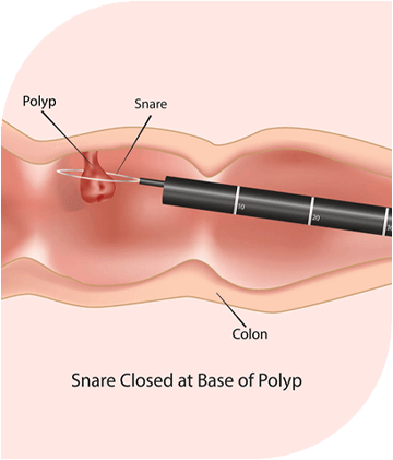 Colonoscopy a screening colonoscopies snare closed poly