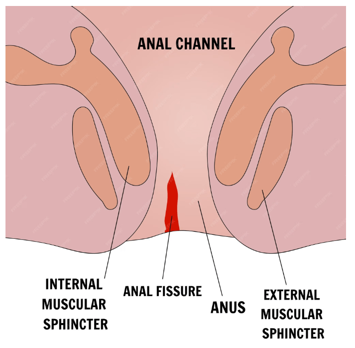 anal fissure fort lauderdale