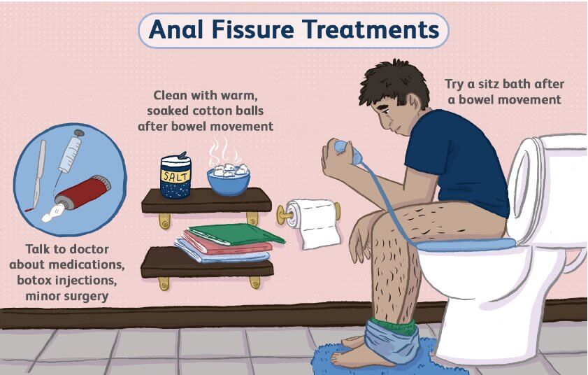 anal fissure treatment fort lauderdale