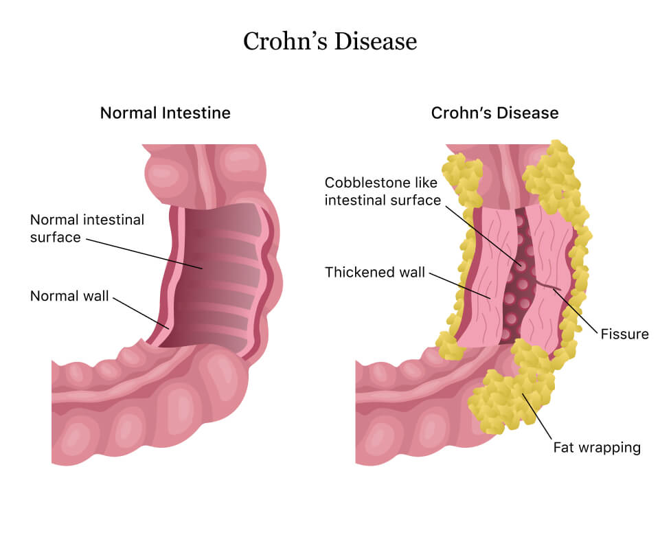 Crohns Disease IBD Fort Lauderdale treatment