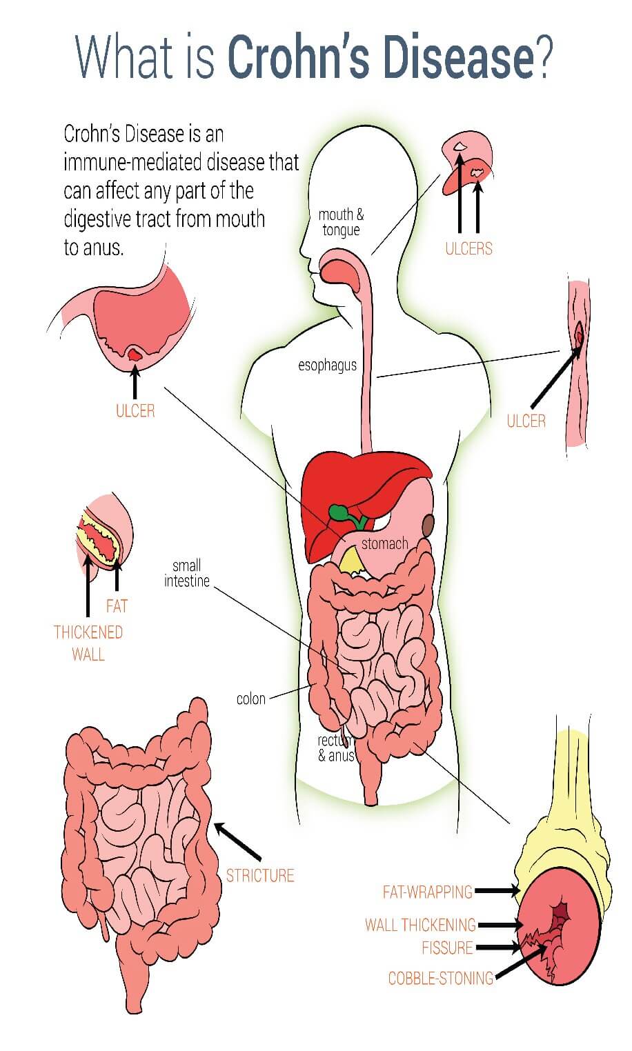Crohns Disease Symptoms Fort lauderdale