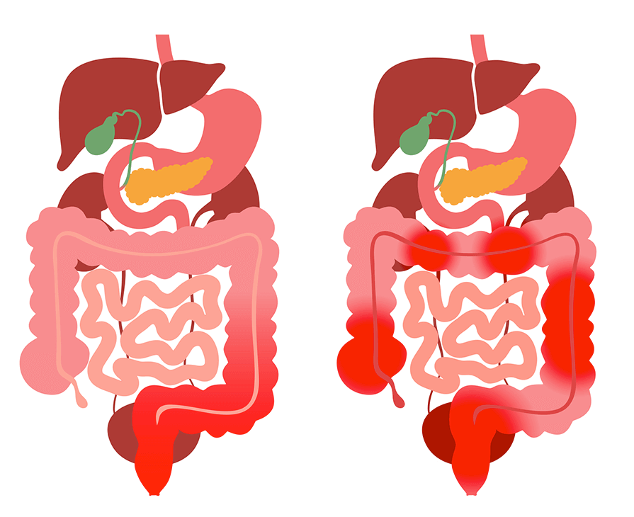 crohns disease treatment fort lauderdale
