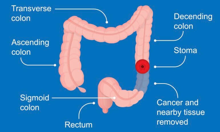 Colon and Rectal Cancer symptoms in Fort Lauderdale, FL, Pompano Beach, FL, Deerfield Beach, FL, Wilton Manor, FL, Oakland Park, FL, Davie, FL, Plantation, FL, Coral Springs, FL, Margate, FL, Coconut Creek, FL and surrounding area of Broward County, Florida