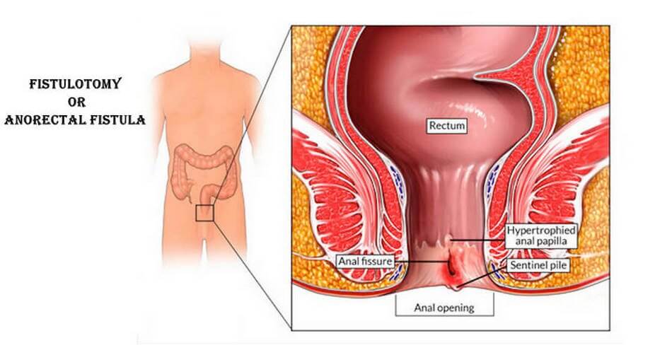 Fistula Rectal Surgery Fistulotomy, Anal Fistula