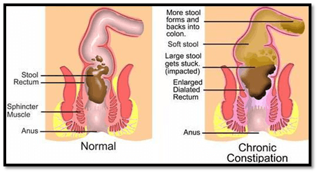 severe constipation chronic constipation treatment