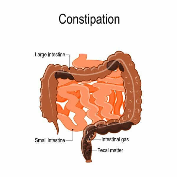 Severe constipation or Chronic Constipation in Fort Lauderdale, FL, Pompano Beach, FL, Deerfield Beach, FL, Wilton Manor, FL, Oakland Park, FL, Davie, FL, Plantation, FL, Coral Springs, FL, Margate, FL, Coconut Creek, FL, and surrounding area of Broward County, FL