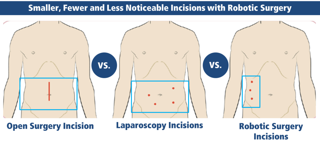 Umbilical Herniorrhaphy, Hernia Repair Surgery In Broward County, FL