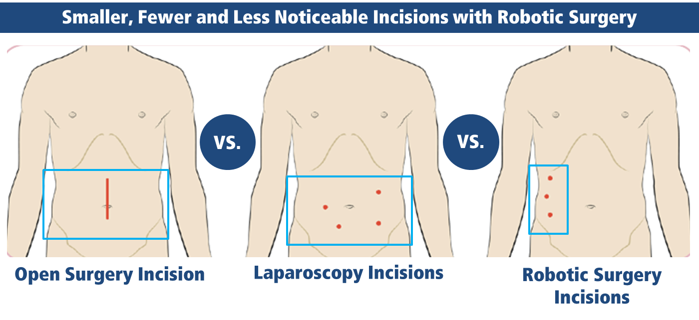 umbilical herniorrhaphy pompano beach broward county