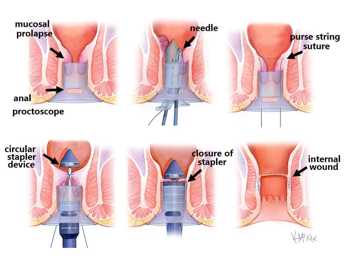Rectal Prolapse Surgery Broward County Florida