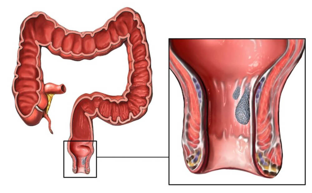 Rectal Prolapse Procedures in Fort Lauderdale, FL, Pompano Beach, FL, Deerfield Beach, FL, Wilton Manor, FL, Oakland Park, FL, Davie, FL, Plantation, FL, Coral Springs, FL, Margate, FL, Coconut Creek, FL and surrounding area of Broward County, Florida