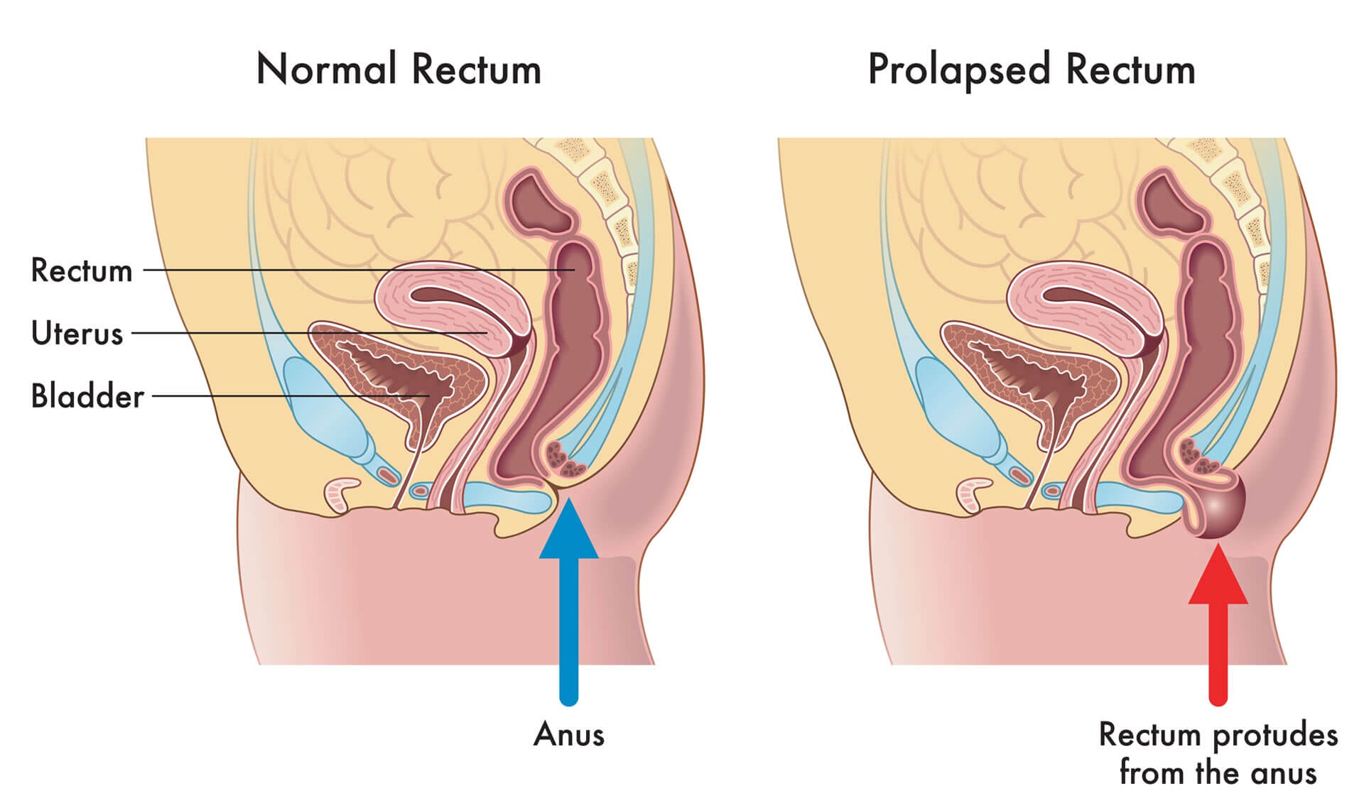 Rectal Prolapse Procedures in Fort Lauderdale Florida Dr Bhatt Fort Lauderdale, FL, Pompano Beach, FL, Deerfield Beach, FL, Wilton Manor, FL, Oakland Park, FL, Davie, FL, Plantation, FL, Coral Springs, FL, Margate, FL, Coconut Creek, FL and surrounding area of Broward County, Florida