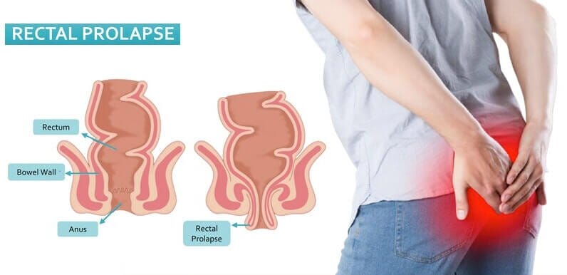 Rectal Prolapse Surgical Treatment Broward County Florida