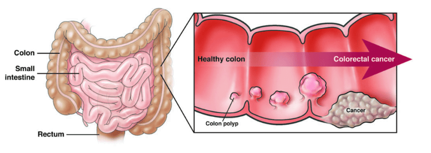 Definitive Advancement in Colon And Rectal Cancer