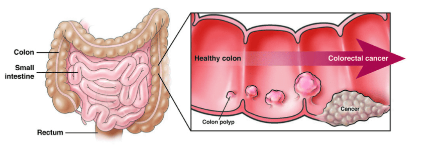Definitive Advancement in Colon And Rectal Cancer