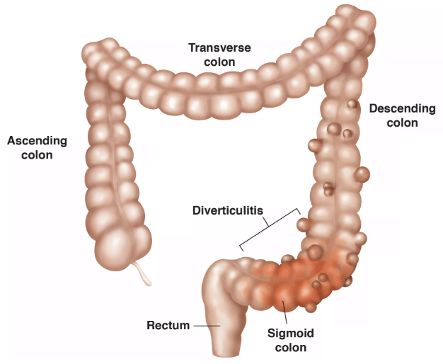 diverticulosis in the sigmoid colon and in the descending colon icd 10