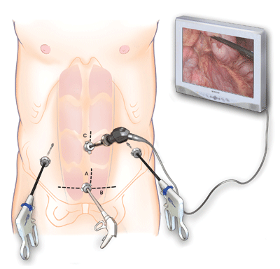 About Diverticulitis Surgery