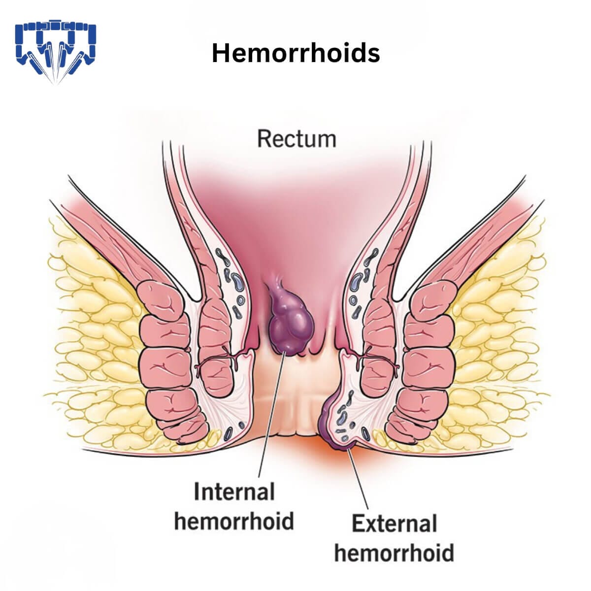 Hemorrhoids