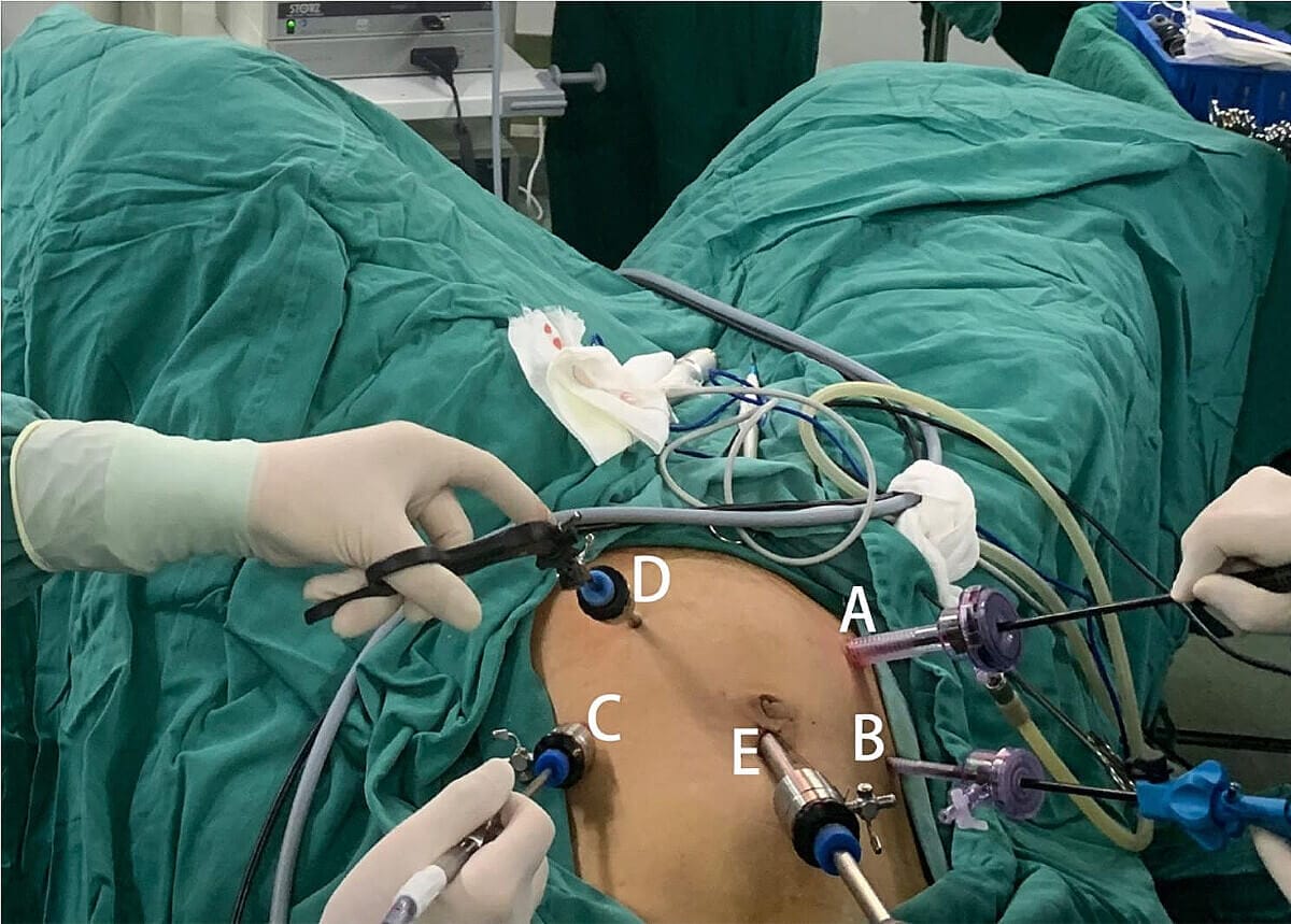 Understanding Traditional (Open) Diverticulitis Surgery